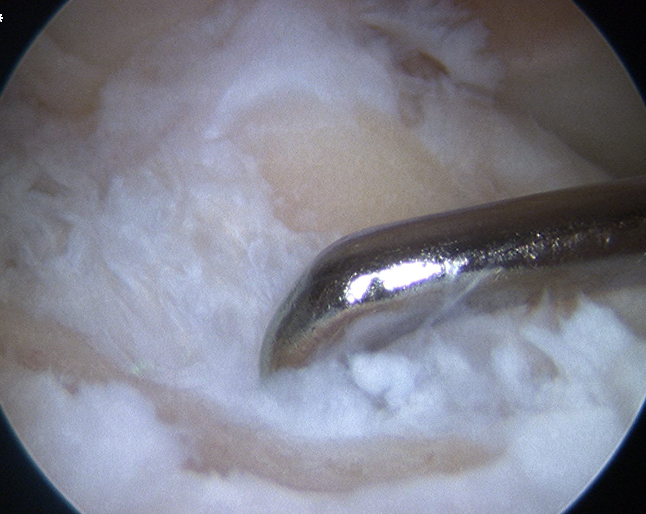 Revision ACL Old Tibial Tunnel